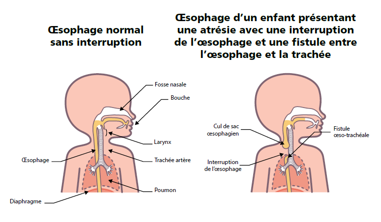 Atrésie de l'œsophage