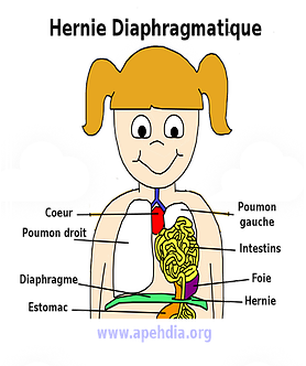 Astrésie de l'œsophage